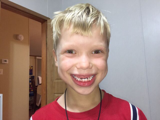 Boy smiling with his two front teeth missing